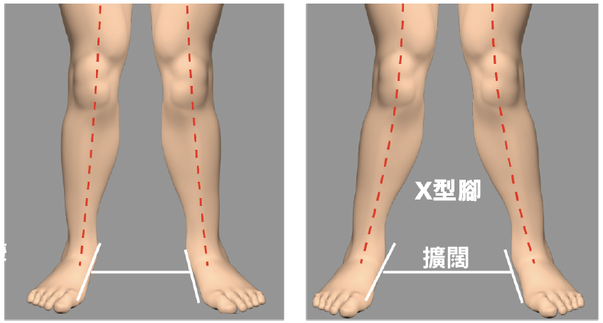 X-leg comparison